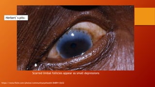 Herbert´s pits:
Scarred limbal follicles appear as small depressions
https://www.flickr.com/photos/communityeyehealth/8489112632
 