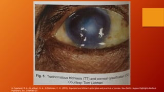 In Copeland, R. A., In Afshari, N. A., & Dohlman, C. H. (2013). Copeland and Afshari's principles and practice of cornea. New Delhi: Jaypee-Highlights Medical
Publishers, Inc. CHAPTER 27.
 