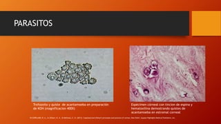PARASITOS
Trofozoito y quiste de acantamoeba en preparación
de KOH (magnificacion 400X)
Espécimen córneal con tincion de espina y
hematoxilina demostrando quistes de
acantamoeba en estromal corneal
IN COPELAND, R. A., In Afshari, N. A., & Dohlman, C. H. (2013). Copeland and Afshari's principles and practice of cornea. New Delhi: Jaypee-Highlights Medical Publishers, Inc.
 