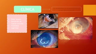 CLÍNICA La variabilidad en la presentación es
lo que diferencia a AK
 Dolor severo
 Sensación de
cuerpo extraño
 Fotofobia
 Lagrimeo
 