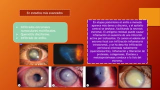 En estadios más avanzados
 Infiltrados estromales
numoculares multifocales.
 Queratitis disciforme.
 Infiltrado de anillo.
En etapas posteriores el anillo a menudo
aparece más denso y discreto, y el epitelio
central se deshace, facilitando la necrosis
estromal. El antígeno residual puede causar
inflamación en ausencia de una infección
activa por trofozoítos. Es común el edema del
estroma focal con infiltración inflamatoria
intrastromal, y se ha descrito infiltración
perineural orientada radialmente
(queratoneuritis), inflamación y liberación de
proteasas, colagenasas, Elastasa y
metaloproteinasas conduce a la lisis del
estroma.
 