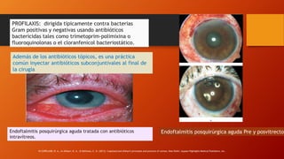 PROFILAXIS: dirigida típicamente contra bacterias
Gram positivas y negativas usando antibióticos
bactericidas tales como trimetoprim-polimixina o
fluoroquinolonas o el cloranfenicol bacteriostático.
Además de los antibióticos tópicos, es una práctica
común inyectar antibióticos subconjuntivales al final de
la cirugía
Endoftalmitis posquirúrgica aguda Pre y posvitrectomEndoftalmitis posquirúrgica aguda tratada con antibióticos
intravítreos.
IN COPELAND, R. A., In Afshari, N. A., & Dohlman, C. H. (2013). Copeland and Afshari's principles and practice of cornea. New Delhi: Jaypee-Highlights Medical Publishers, Inc.
 