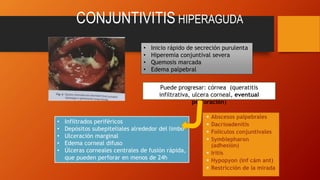 CONJUNTIVITIS HIPERAGUDA
• Inicio rápido de secreción purulenta
• Hiperemia conjuntival severa
• Quemosis marcada
• Edema palpebral
Puede progresar: córnea (queratitis
infiltrativa, ulcera corneal, eventual
perforación)
• Infiltrados periféricos
• Depósitos subepiteliales alrededor del limbo
• Ulceración marginal
• Edema corneal difuso
• Úlceras corneales centrales de fusión rápida,
que pueden perforar en menos de 24h
 Abscesos palpebrales
 Dacrioadenitis
 Folículos conjuntivales
 Symblepharon
(adhesión)
 Iritis
 Hypopyon (inf cám ant)
 Restricción de la mirada
 