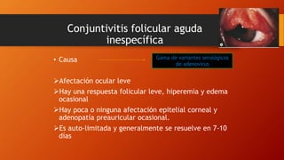 Conjuntivitis folicular aguda
inespecífica
• Causa
Afectación ocular leve
Hay una respuesta folicular leve, hiperemia y edema
ocasional
Hay poca o ninguna afectación epitelial corneal y
adenopatía preauricular ocasional.
Es auto-limitada y generalmente se resuelve en 7-10
días
Gama de variantes serológicos
de adenovirus
 