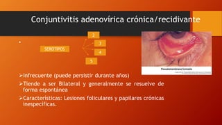 Conjuntivitis adenovírica crónica/recidivante
•
Infrecuente (puede persistir durante años)
Tiende a ser Bilateral y generalmente se resuelve de
forma espontánea
Características: Lesiones foliculares y papilares crónicas
inespecíficas.
2
4
5
3
SEROTIPOS
 