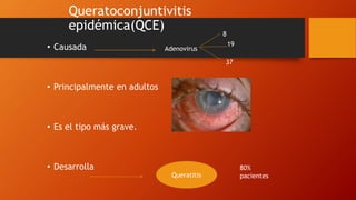 Queratoconjuntivitis
epidémica(QCE)
• Causada
• Principalmente en adultos
• Es el tipo más grave.
• Desarrolla
Adenovirus
8
19
37
Queratitis
80%
pacientes
 