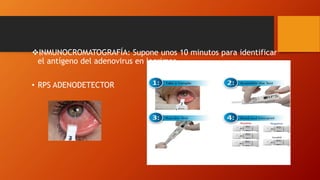 INMUNOCROMATOGRAFÍA: Supone unos 10 minutos para identificar
el antígeno del adenovirus en lagrimas.
• RPS ADENODETECTOR
 