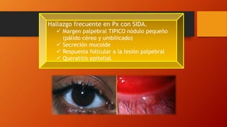 Hallazgo frecuente en Px con SIDA.
 Margen palpebral TIPICO nódulo pequeño
(pálido céreo y umbilicado)
 Secreción mucoide
 Respuesta folicular a la lesión palpebral
 Queratitis epitelial.
 