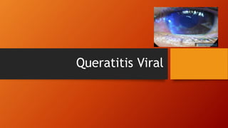 Queratitis Viral
 