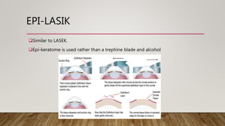 EPI-LASIK
Similar to LASEK.
Epi-keratome is used rather than a trephine blade and alcohol
 