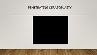 PENETRATING KERATOPLASTY
 