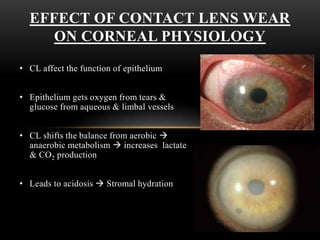 EFFECT OF CONTACT LENS WEAR 
ON CORNEAL PHYSIOLOGY 
• CL affect the function of epithelium 
• Epithelium gets oxygen from tears & 
glucose from aqueous & limbal vessels 
• CL shifts the balance from aerobic  
anaerobic metabolism  increases lactate 
& CO2 production 
• Leads to acidosis  Stromal hydration 
 