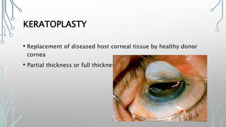 CORNEAL AND REFRACTIVE SURGERY | PPTX