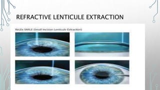 CORNEAL AND REFRACTIVE SURGERY | PPTX