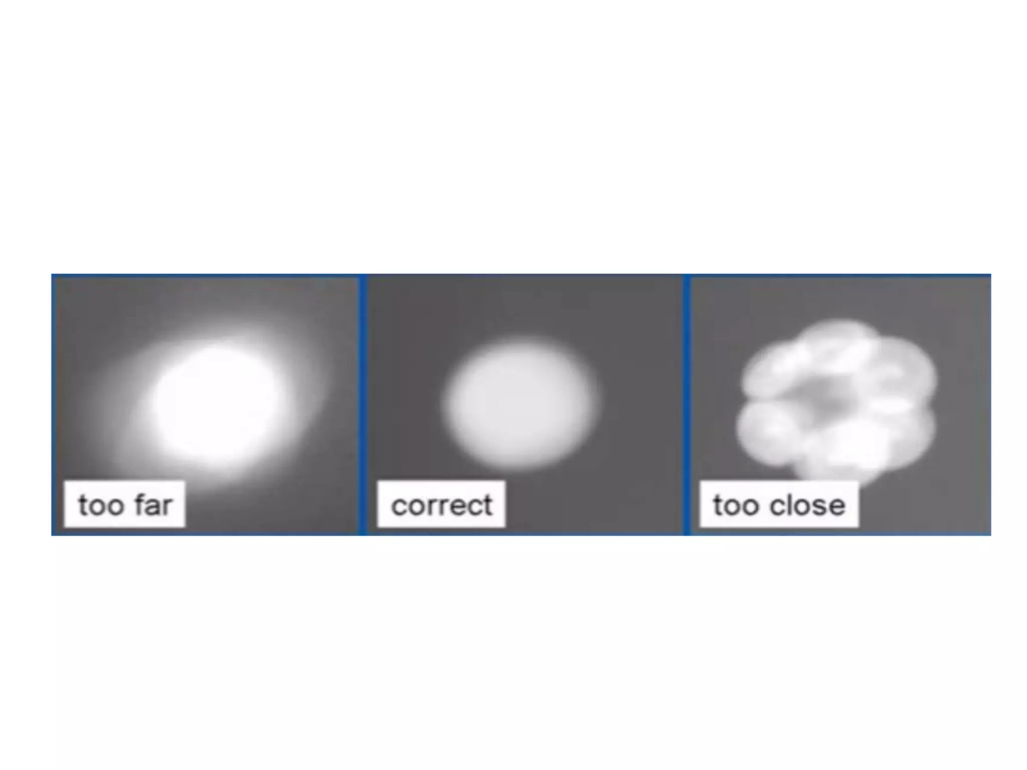 Corneal collagen cross linking | PPTX