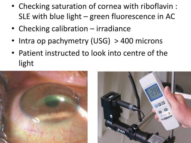 Corneal collagen cross linking | PPTX | Eye and Vision Conditions ...