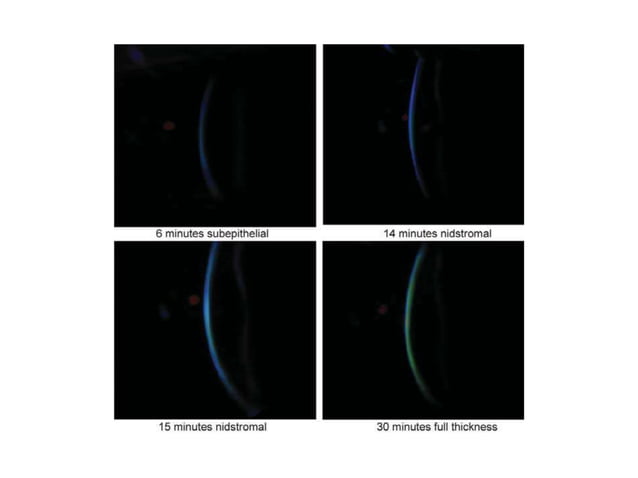 Corneal collagen cross linking | PPTX | Eye and Vision Conditions ...