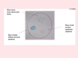 Tells about corneal colour coding ,and depicting there images | PPTX