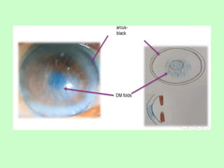 Tells about corneal colour coding ,and depicting there images | PPTX