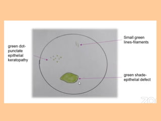 Tells about corneal colour coding ,and depicting there images | PPTX