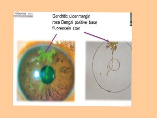 Tells about corneal colour coding ,and depicting there images | PPTX