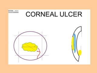 Tells about corneal colour coding ,and depicting there images | PPTX