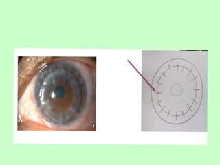 Tells about corneal colour coding ,and depicting there images | PPTX