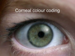 Corneal colour coding
 