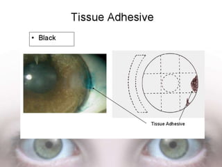 Eye colour coding | PPTX