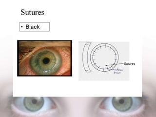 Cornea Diagram Colour Coding