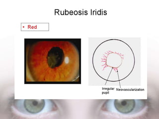 Eye colour coding | PPTX