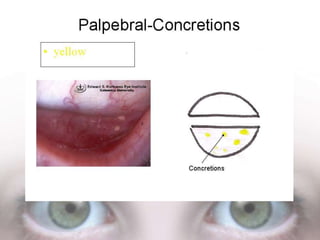 Eye colour coding | PPTX