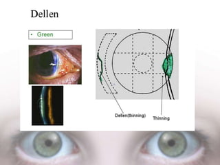 Eye colour coding | PPTX