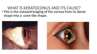 WHAT IS KERATOCONUS AND ITS CAUSE?
•This is the outward bulging of the cornea from its dome
shape into a cone-like shape.
 