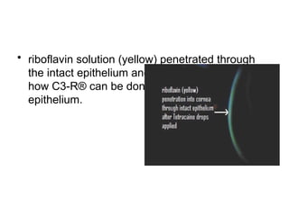 • riboflavin solution (yellow) penetrated through
the intact epithelium and into the cornea which is
how C3-R® can be done without scraping off the
epithelium.
 