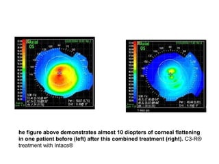 he figure above demonstrates almost 10 diopters of corneal flattening
in one patient before (left) after this combined treatment (right). C3-R®
treatment with Intacs®
 