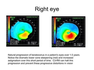 Right eye
Natural progression of keratoconus in a patient’s eyes over 1.5 years.
Notice the dramatic lower cone steepening (red) and increased
astigmatism over this short period of time. C3-R® can halt this
progression and prevent these progressive distortions in vision
 