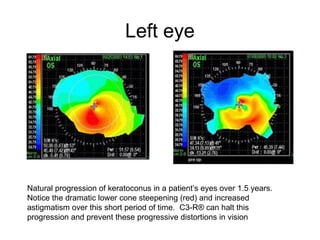 Left eye
Natural progression of keratoconus in a patient’s eyes over 1.5 years.
Notice the dramatic lower cone steepening (red) and increased
astigmatism over this short period of time. C3-R® can halt this
progression and prevent these progressive distortions in vision
 