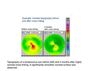 Topography of a keratoconus eye before (left) and 4 months after (right)
corneal cross linking. A significantly smoother corneal surface was
observed.
 