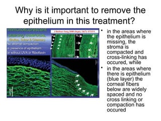 Why is it important to remove the
epithelium in this treatment?
• in the areas where
the epithelium is
missing, the
stroma is
compacted and
cross-linking has
occured, while
• in the areas where
there is epithelium
(blue layer) the
corneal fibers
below are widely
spaced and no
cross linking or
compaction has
occured
 