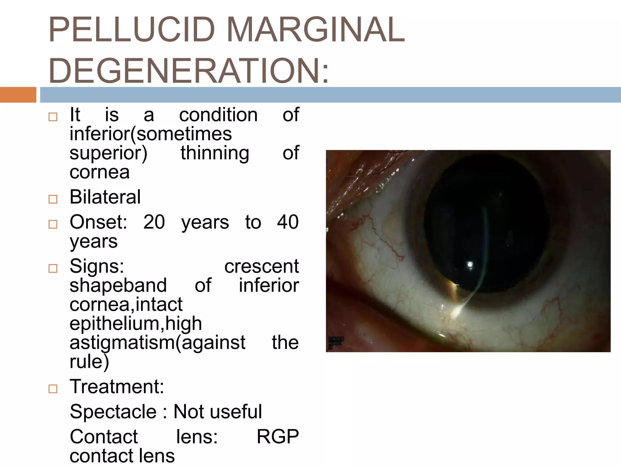 Corneal curvature and thickness | PPTX