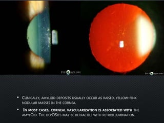 • CLINICALLY, AMYLOID DEPOSITS USUALLY OCCUR AS RAISED, YELLOW-PINK
NODULAR MASSES IN THE CORNEA.
•
 
