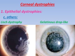Corneal Degeneration Dystrophies PPTX
