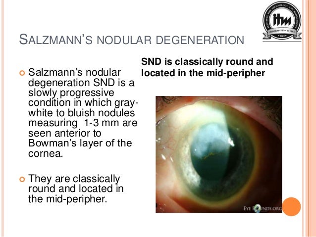 Salzmann Nodular Degeneration Salzmann Nodular Degeneration