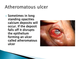  Sometimes in long
standing opacities
calcium deposits will
occur. If the deposit
falls off it disrupts
the epithelium
forming an ulcer
called atheromatous
ulcer
 