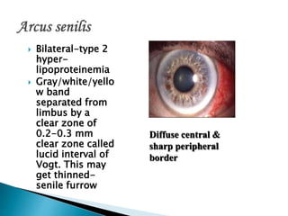  Bilateral-type 2
hyper-
lipoproteinemia
 Gray/white/yello
w band
separated from
limbus by a
clear zone of
0.2-0.3 mm
clear zone called
lucid interval of
Vogt. This may
get thinned-
senile furrow
Diffuse central &
sharp peripheral
border
 