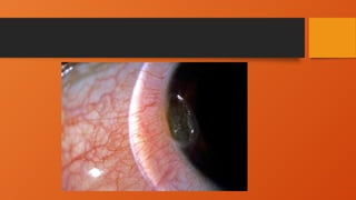 Comprehensive Overview of Corneal Dellen: Causes, Features, and ...