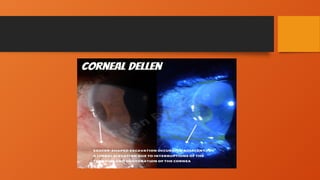 Comprehensive Overview of Corneal Dellen: Causes, Features, and ...