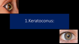 1.Keratoconus:
 