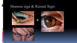Munson sign & Rizzuti Sign:
&
 